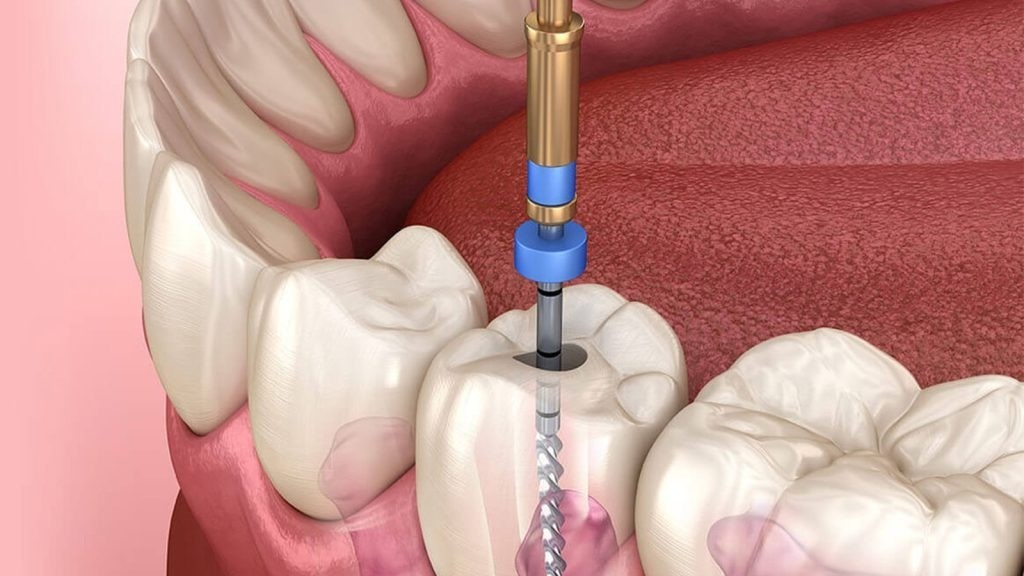 Kanal Tedavisi Ağrılı Mıdır?