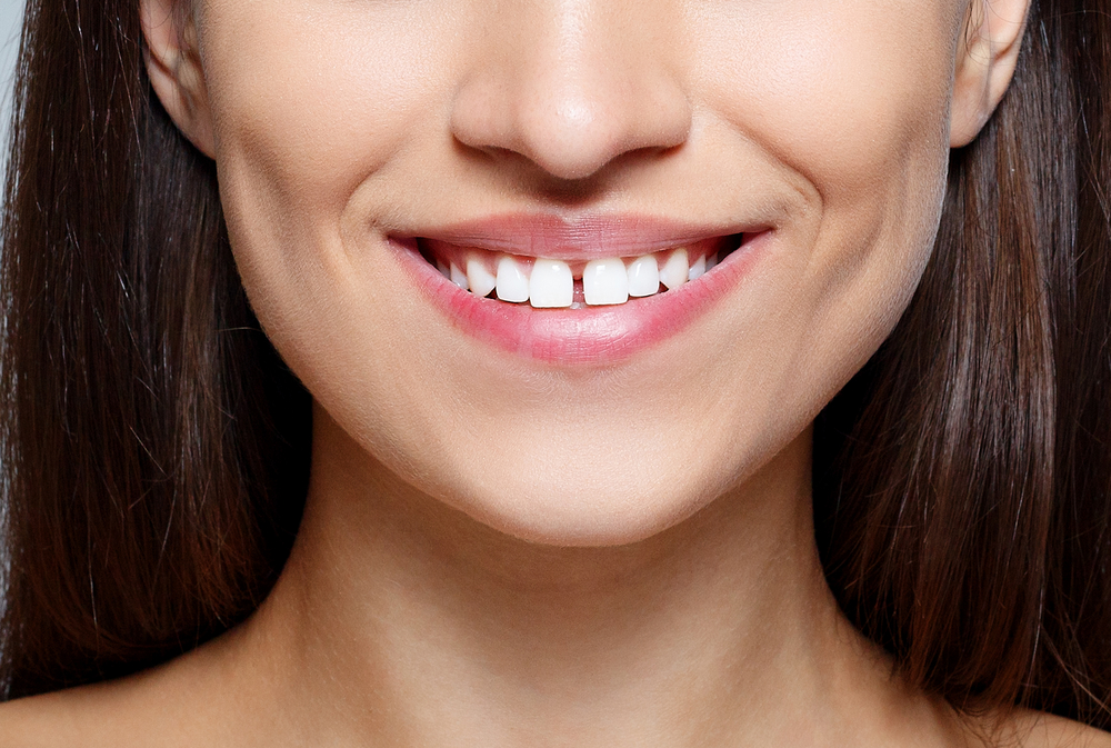 Diastema (Diş Arası Boşluğu) Nasıl Kapatılır?