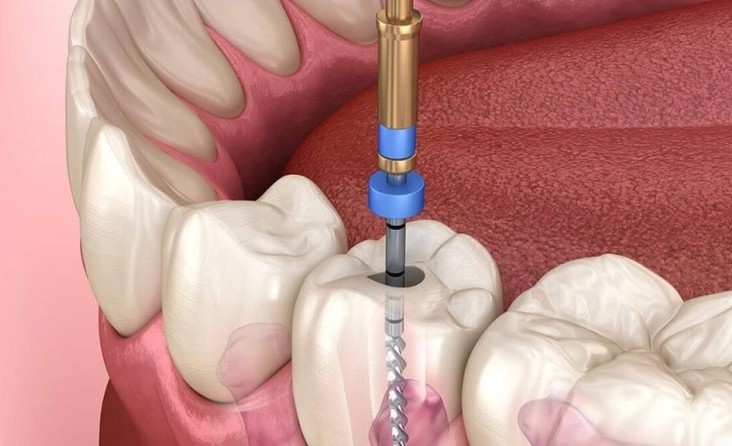 Dental İmplant