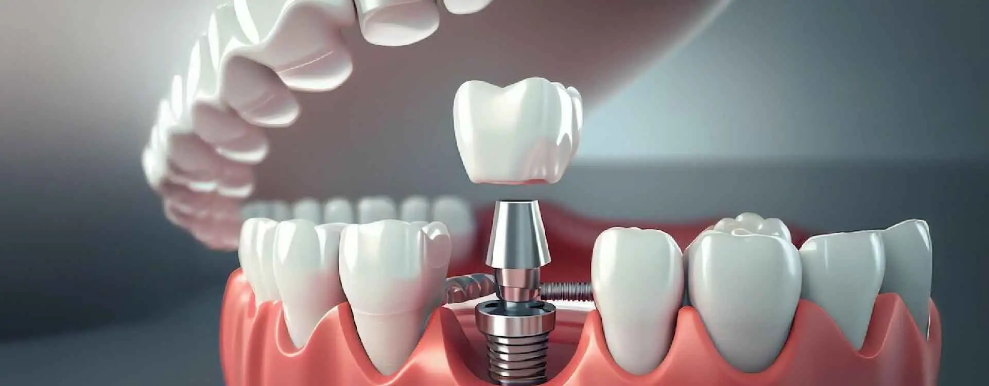 1 Günde İmplant Nedir? Aynı Gün Geçici Diş Takılması